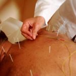 Kemoterapi ve akupunktur
